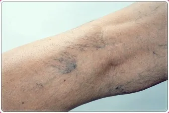 하지 정맥류 증상 치료방법과 예방 생활습관_20