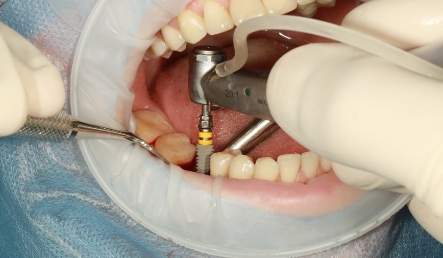 대전-중구-임플란트-치과-가격-비용-싼-곳,저렴한-곳,잘하는-곳,유명한-곳-BEST20-추천10