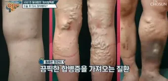 하지 정맥류 증상 치료방법과 예방 생활습관_9