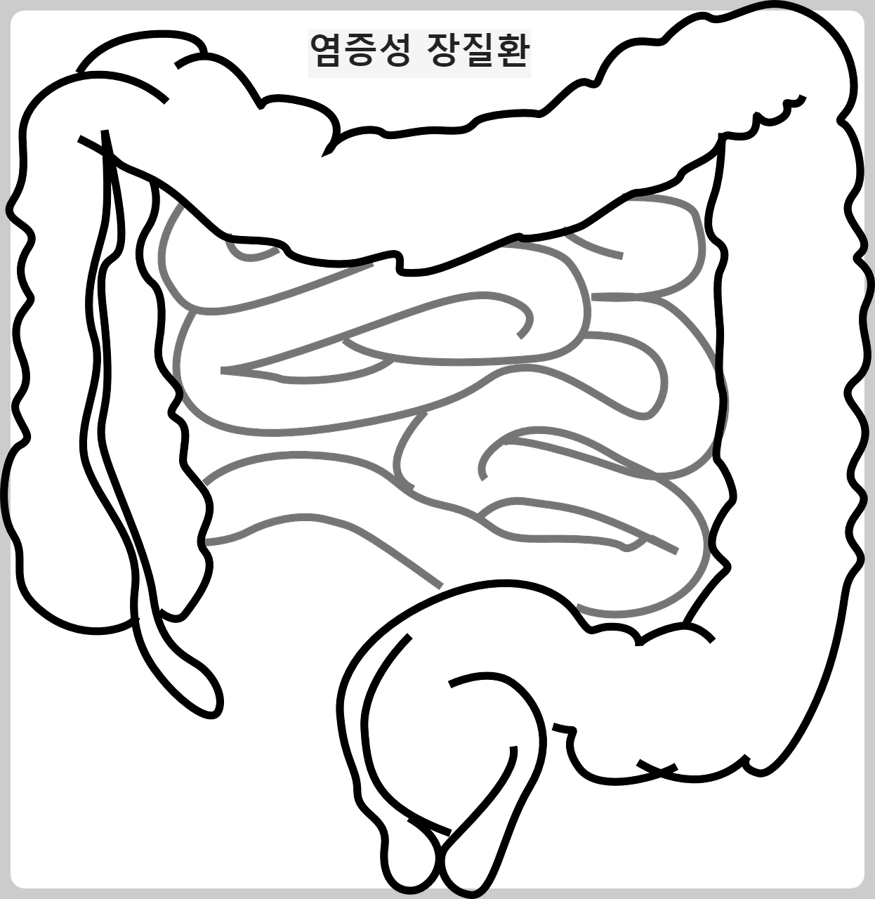 염증성 장질환