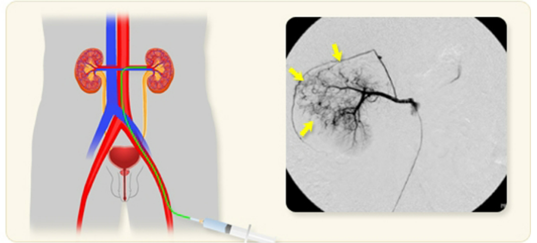 신동맥 색전술 정리