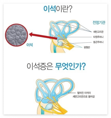 이석증