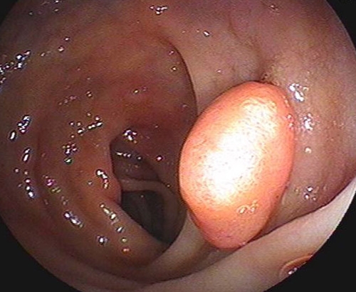 대장 내시경 검사에서 흔하게 발견하는 것이 바로 점막이 비정상적으로 자라서 혹처럼 튀어나온 용종 그림