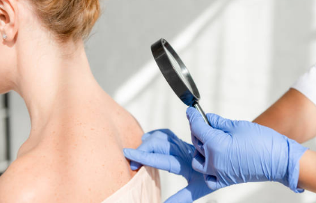 쥐젖 제거방법, 쥐젖이 생기는 이유, 제거 연고 총정리 (2024ver)