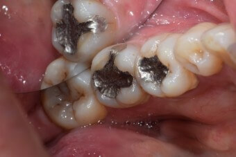 치아-네개를-충치로-뽑아내고-임플란트-해놓은-모습