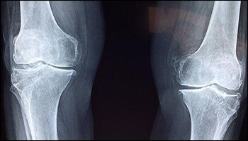 뼈 X-Ray