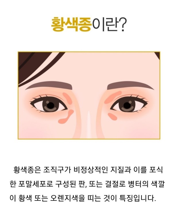 황색종이란?