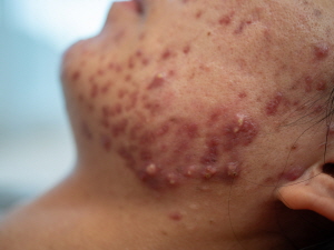 여드름 흉터 없애는법