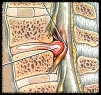 신경차단술과 신경성형술의 차이점