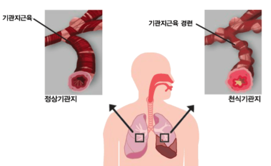 천식 원인