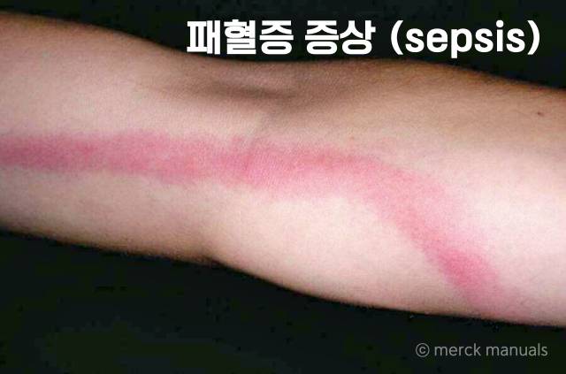 피부에 붉은 선,피부에 붉은자국,패혈증 증상,팁줌