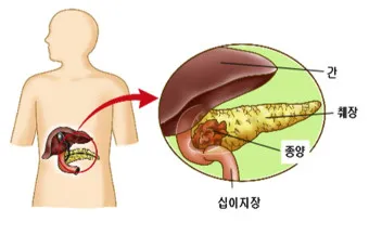 췌장암 초기 증상 췌장암 등통증 위치 검사_13