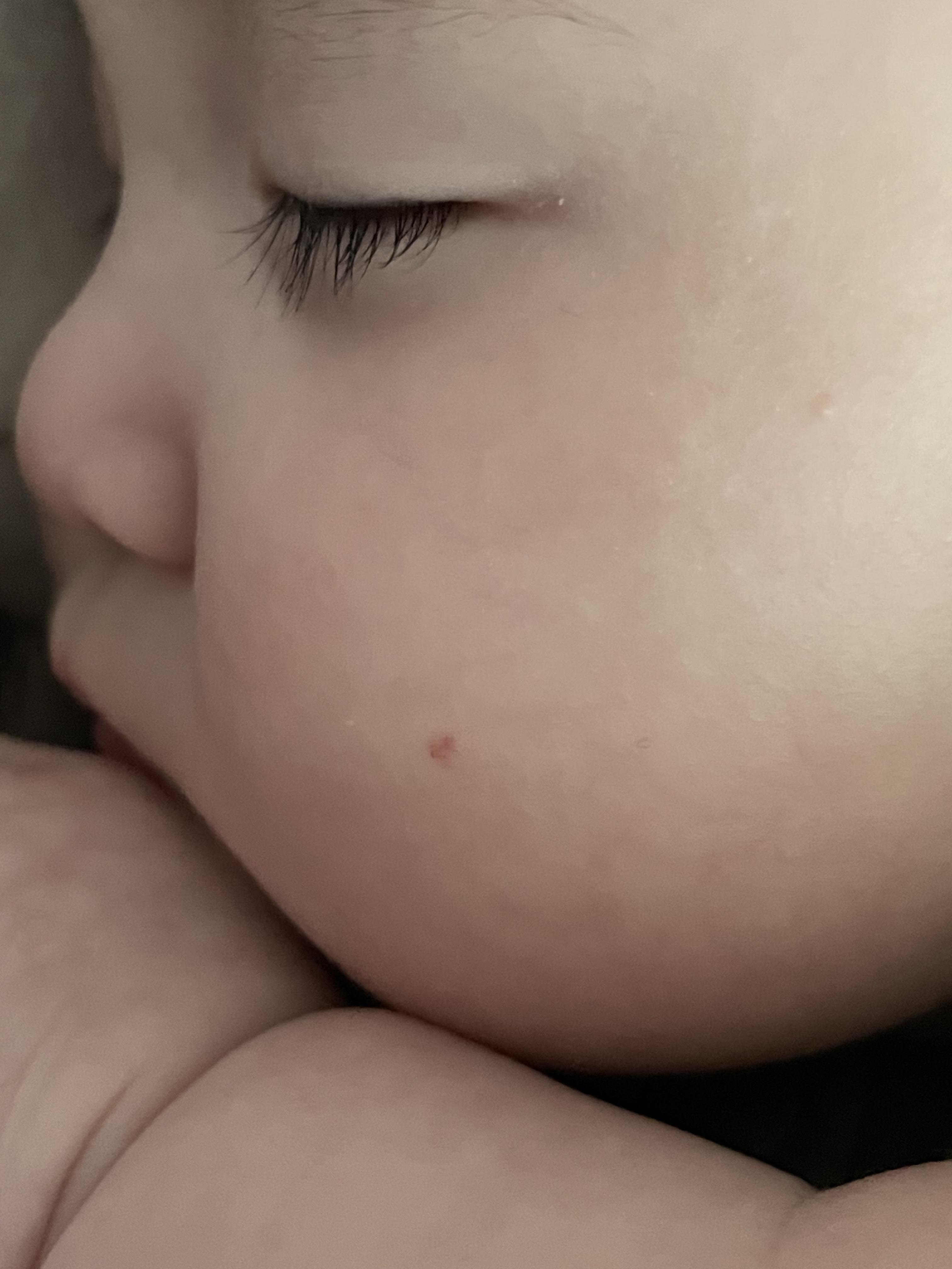 혈관종 에스앤유 피부과