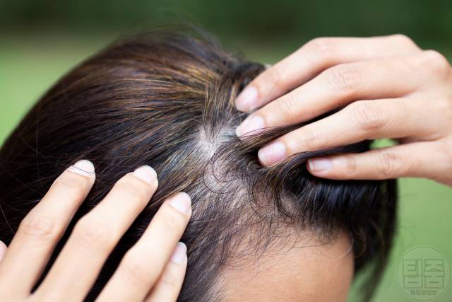 칼슘이 부족하면 나타나는 증상,탈모