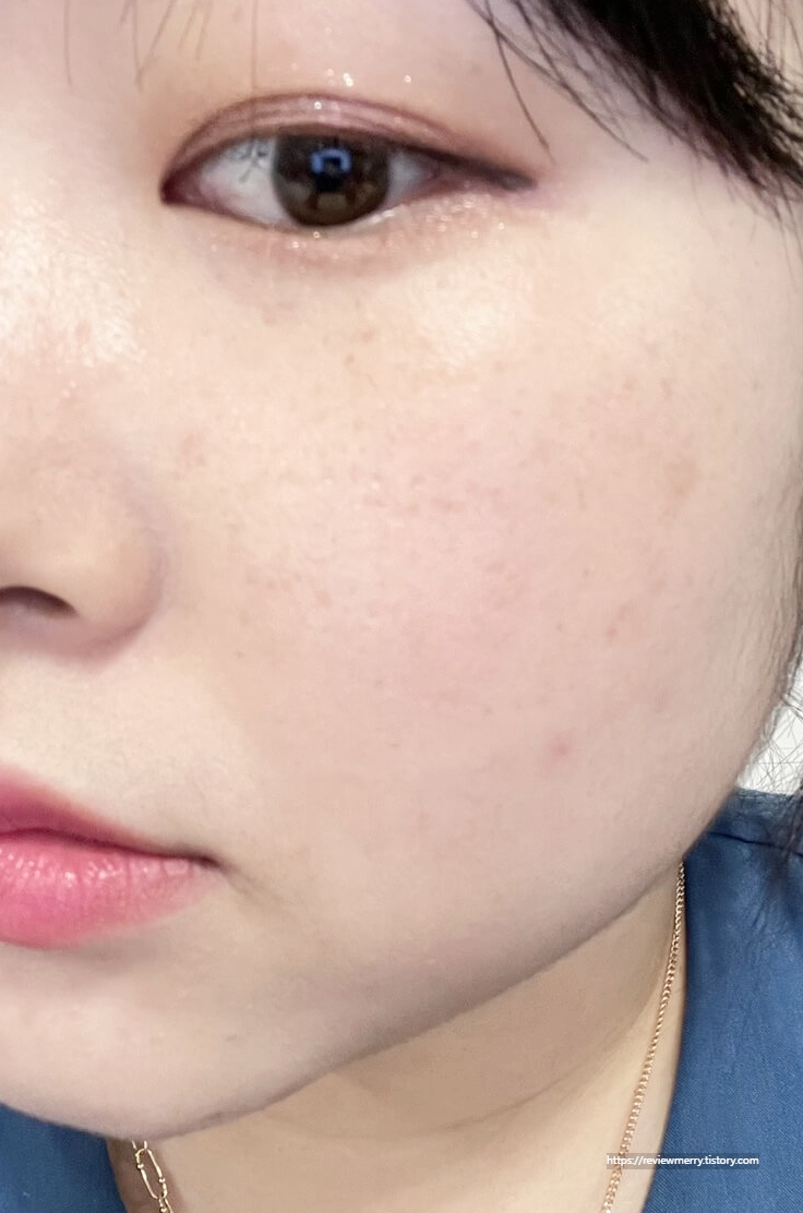 6시간 후 우측 볼