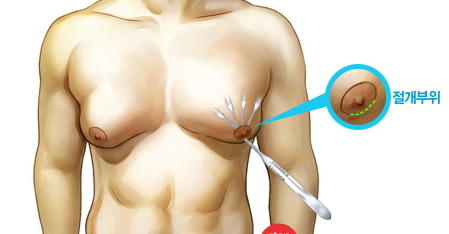 남성여유증 치료 과정 3