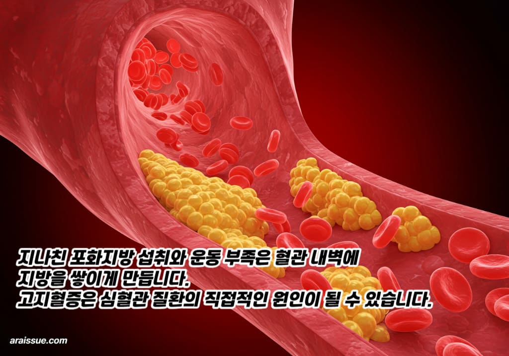 지나친 포화지방 섭취와 운동 부족은 혈관 내벽에 지방을 쌓이게 만듭니다. 고지혈증은 심혈관 질환의 직접적인 원인이 될 수 있어요.