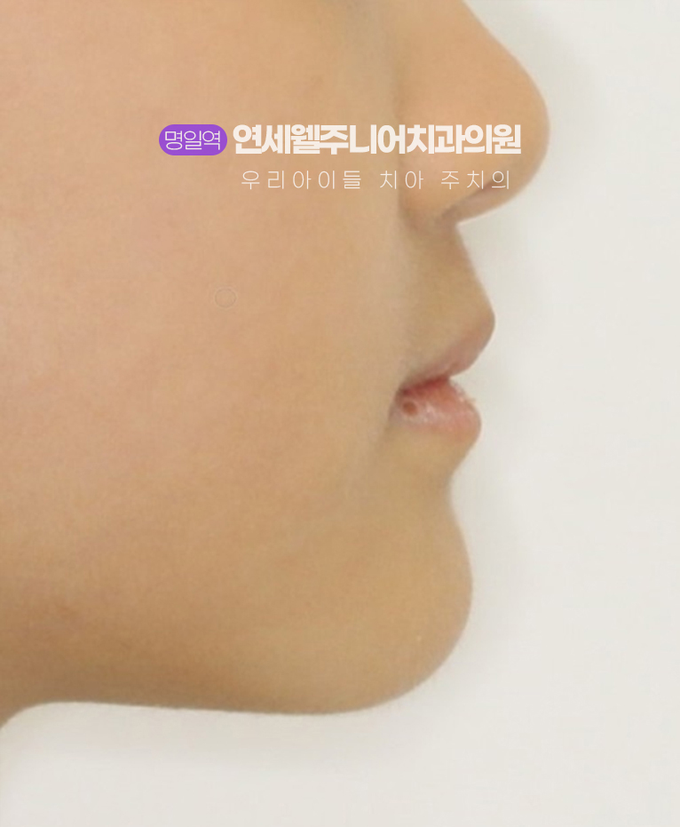 초등학생 주걱턱교정 후 턱과 입술 변화를 확인하는 측면 모습