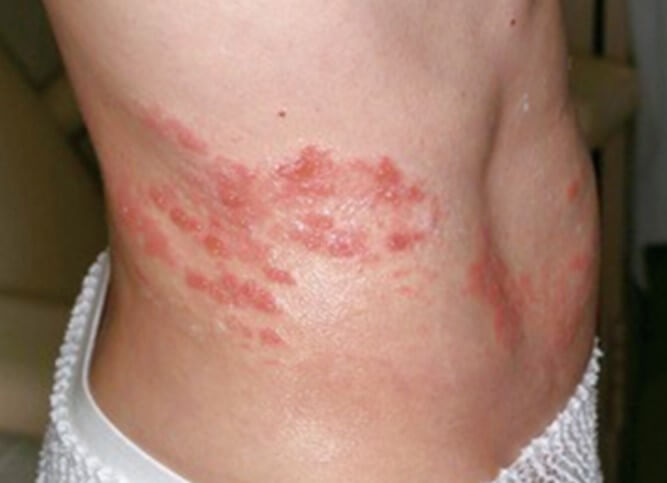 대상포진 초기증상 대상포진 조기치료 대상포진 초기증상 및 조기치료