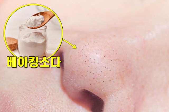 코 피지 제거법, 코 블랙헤드 없애는 방법, 베이킹소다 팩, 팁줌