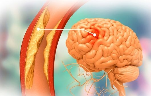 뇌혈관질환 전조증상