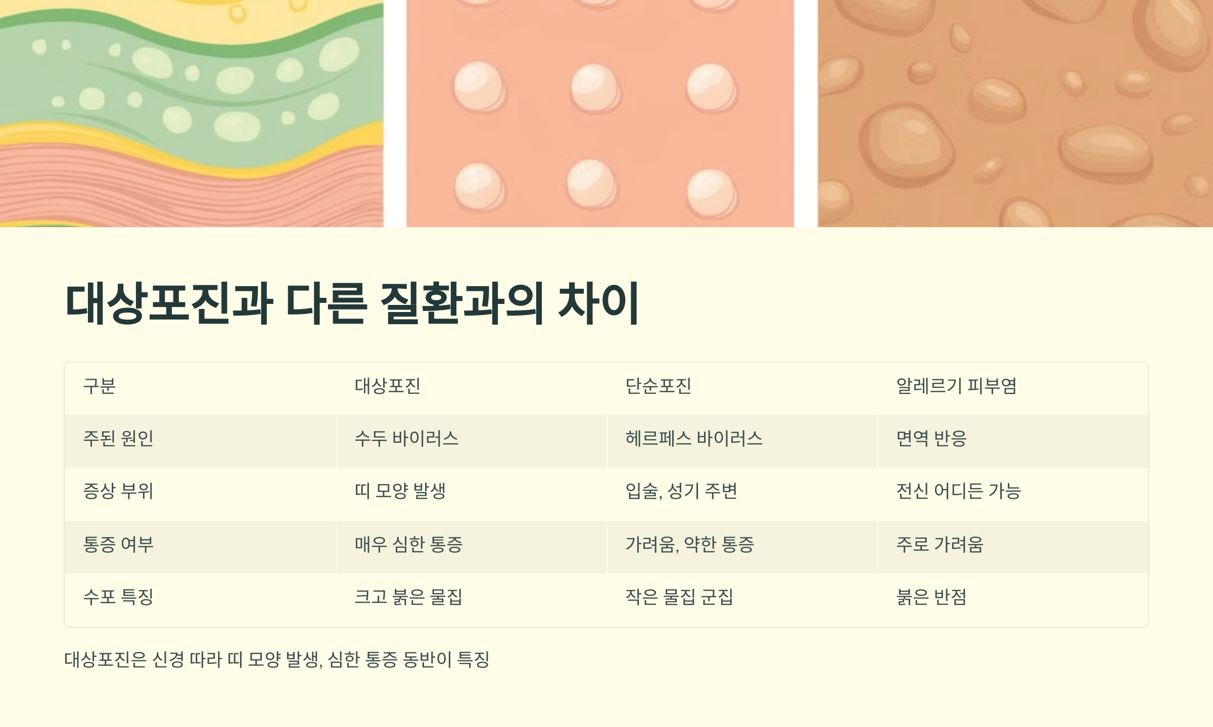 대상포진과 관련된 사진입니다.