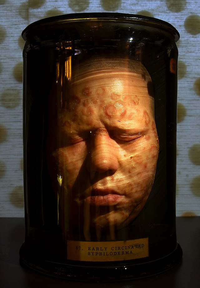 매독 증상과 예방법