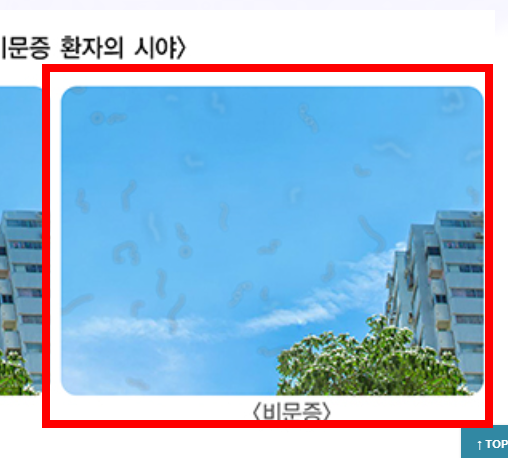 비문증 치료방법 알아보기