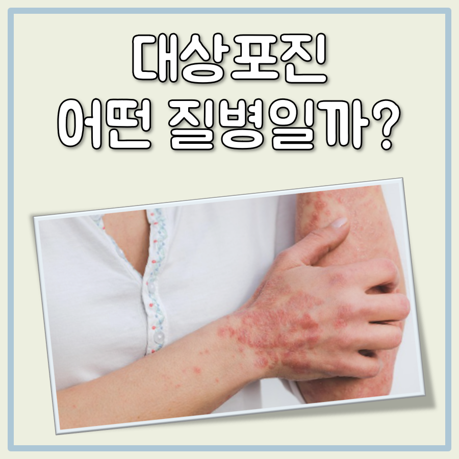 대상포진이란 대표 이미지