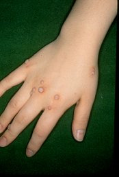 사마귀 원인부터 종류별 증상&middot;치료&middot;관리까지 