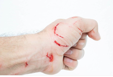 피투성이인 손.