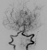 담배연기모양 혈관 모습