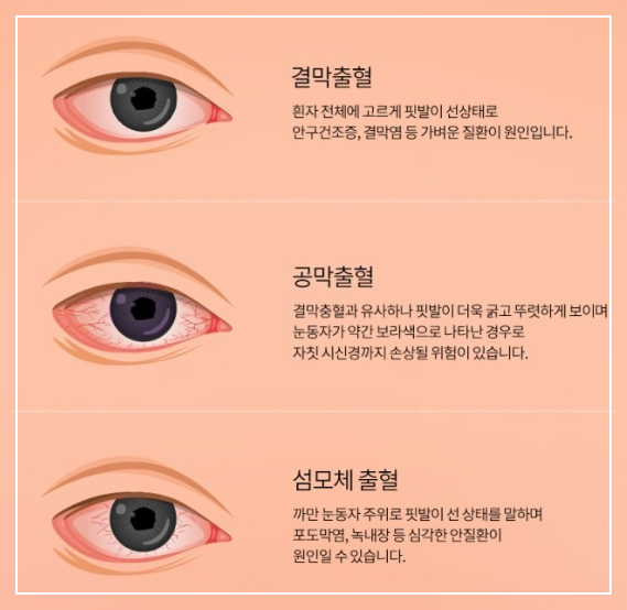 눈충혈(출처 수연세안과)