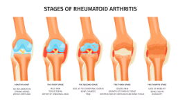콘드로이친 효능 부작용 복용법