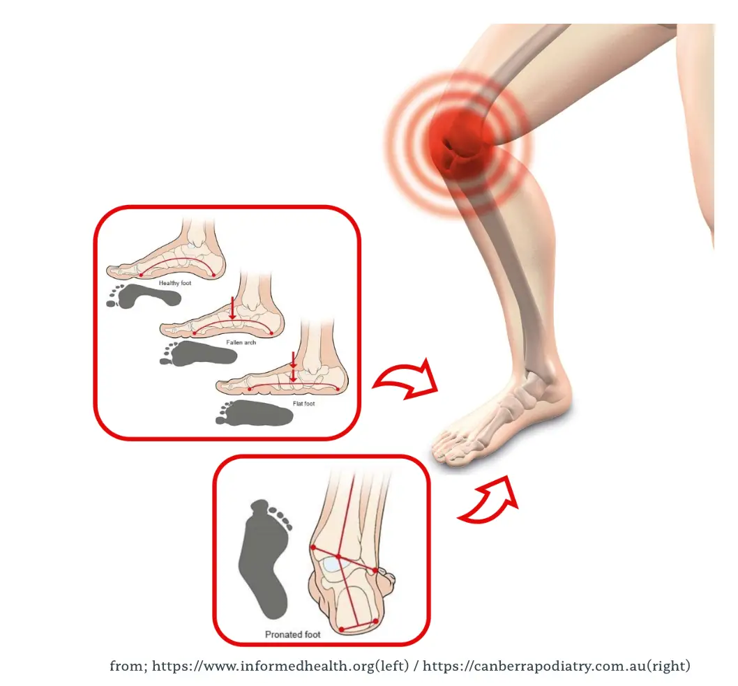 슬개대퇴통증증후군: 원인, 증상 및 효과적인 관리 방법