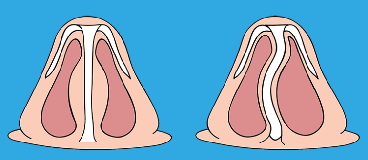 비중격 만곡이란
