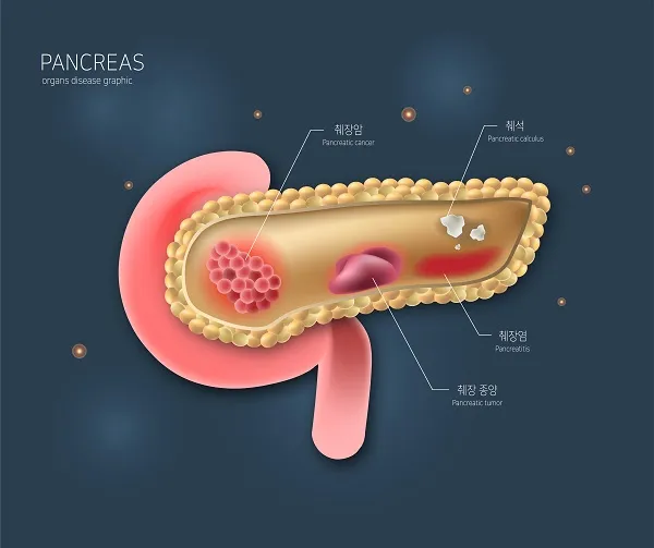 췌장암 의심 증상 여섯가지 발생원인 초기 의심 증상 검사방법 예방법