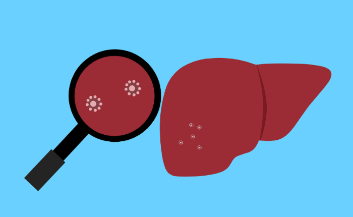 비알코올성 지방간 질환 설명 이미지 간에 지방이 쌓인 지방간을 확대경으로 확인하는 건강 일러스트