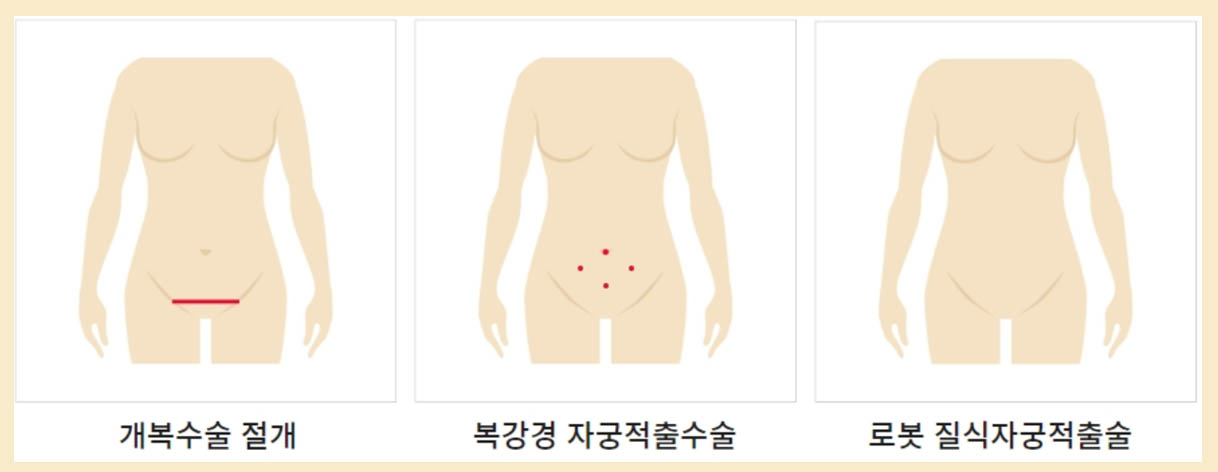 자궁근종 수술방법 비교 그림