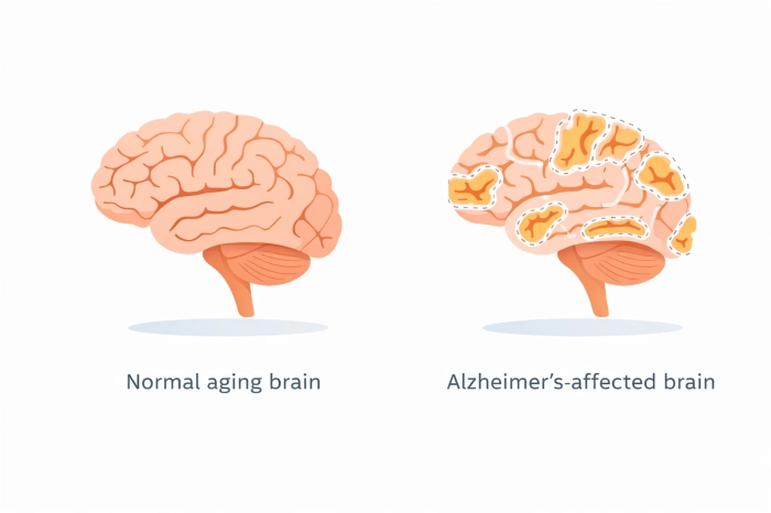 알츠하이머 말기증상