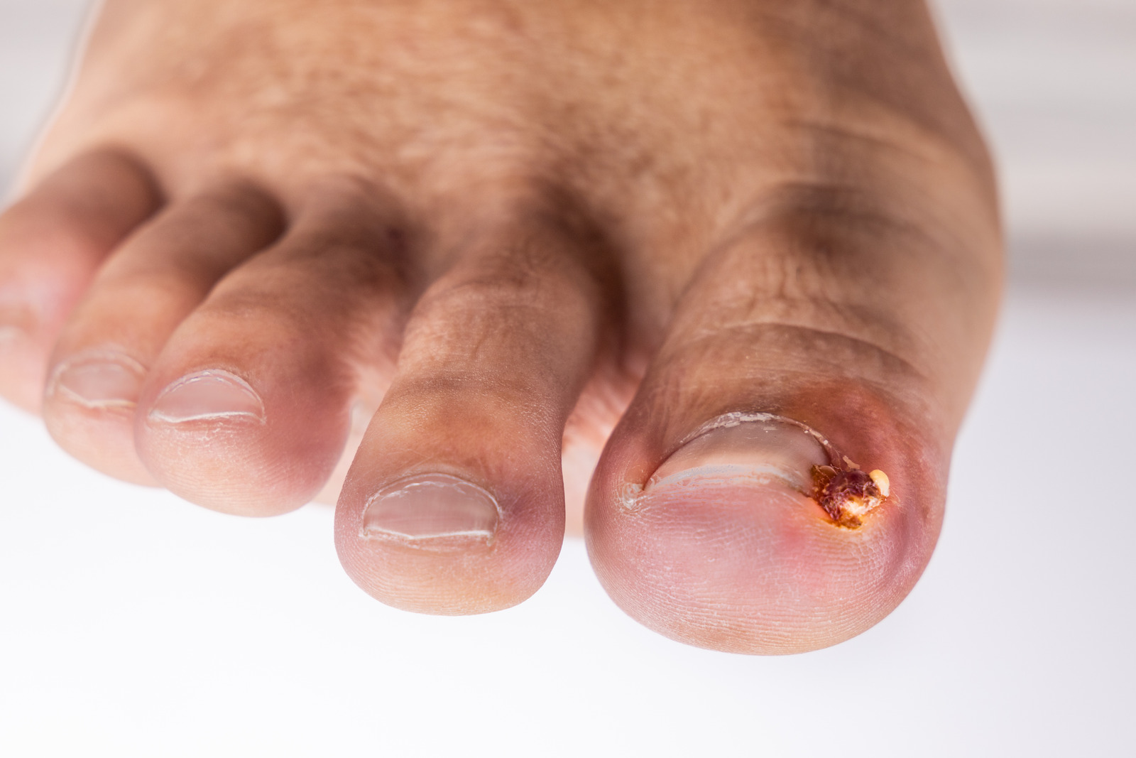 내성 발톱 (Ingrown Toenail) – 원인, 증상 및 치료 방법
