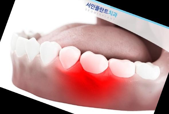 잇몸 내려앉음 치료