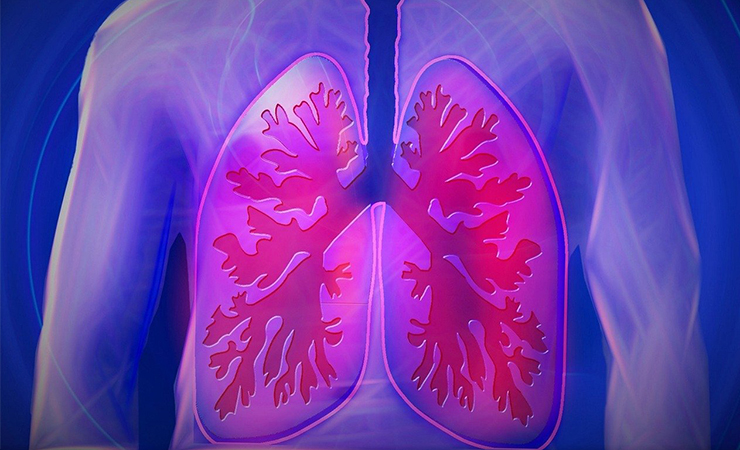 폐렴 초기증상 예방방법 증상 알아보기