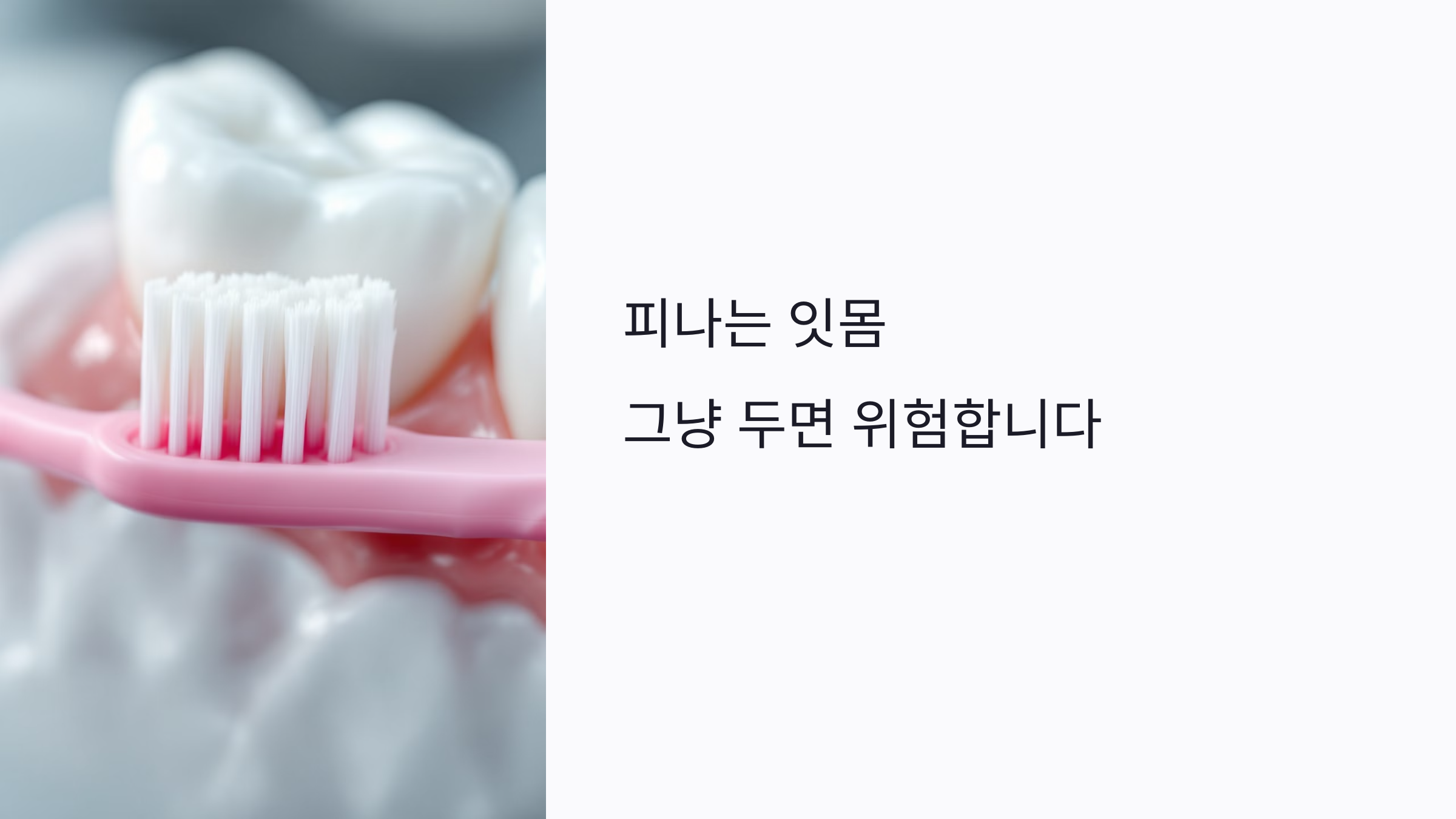 피나는 잇몸 그냥 두면? 초기 잇몸병부터 임플란트 전 레이저치료까지