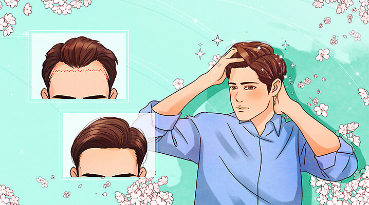 모발이식 부위별 비용