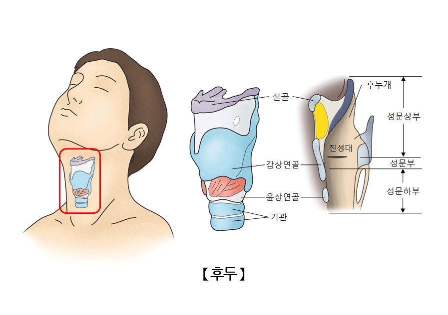 후두암