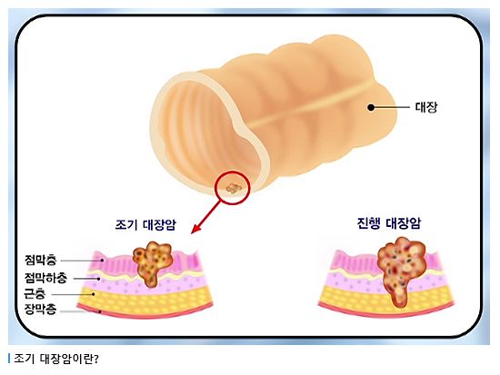 용종과 선종의 차이