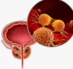 방광염-증상-건강