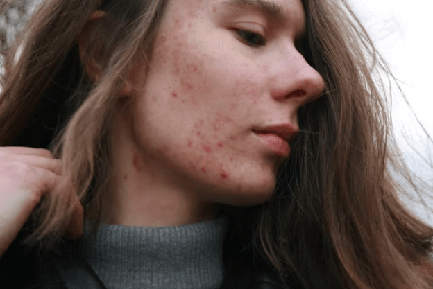 트러블 피부&amp;#44; 꾸준한 관리 3가지 방법