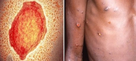 원숭이 두창 바이러스